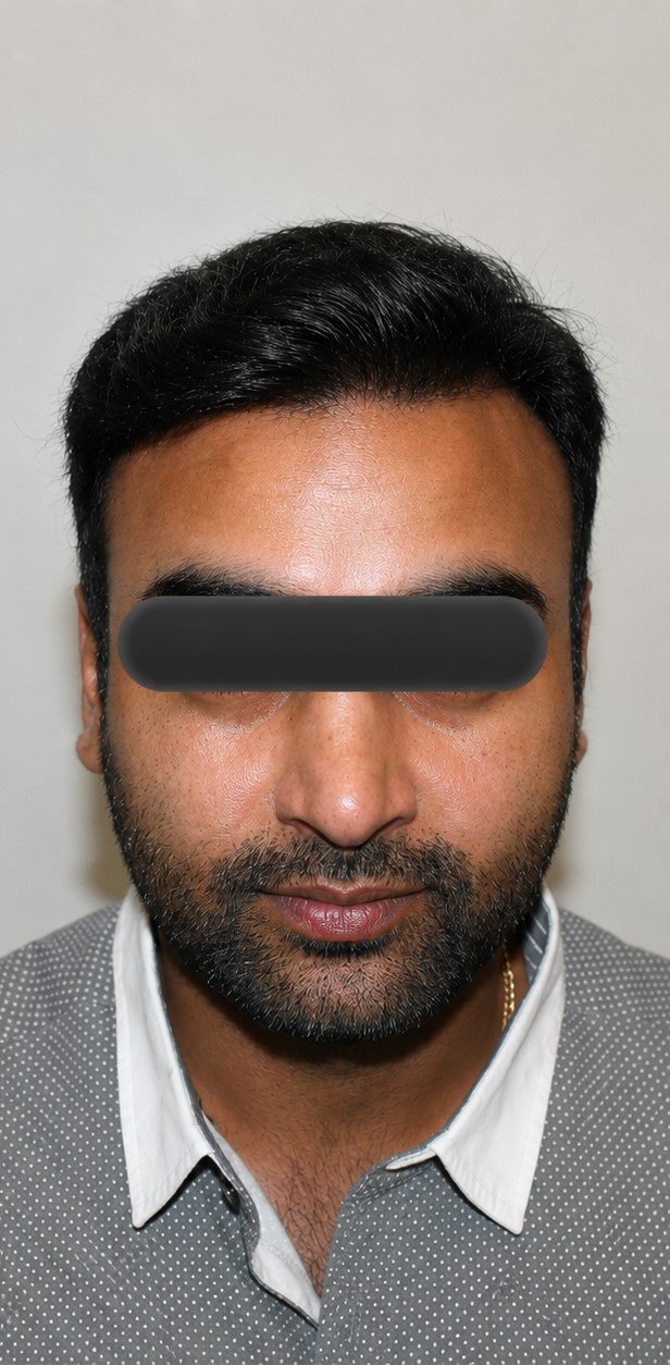 Natural hair growth after hair transplant treatment at Dexa Clinic